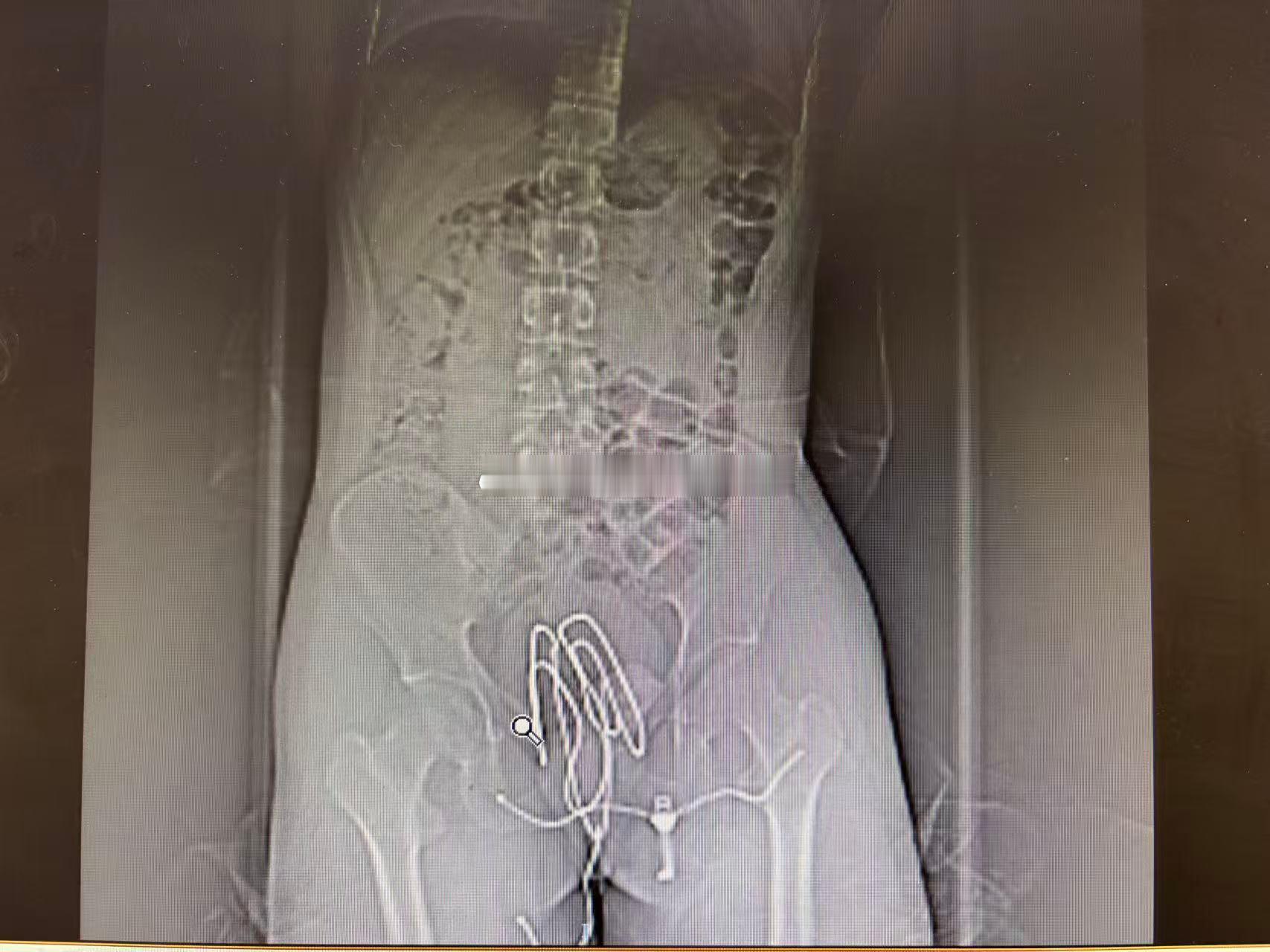 投稿:接了个直肠异物的，18岁小伙子，把晾衣撑子塞进去了。。。