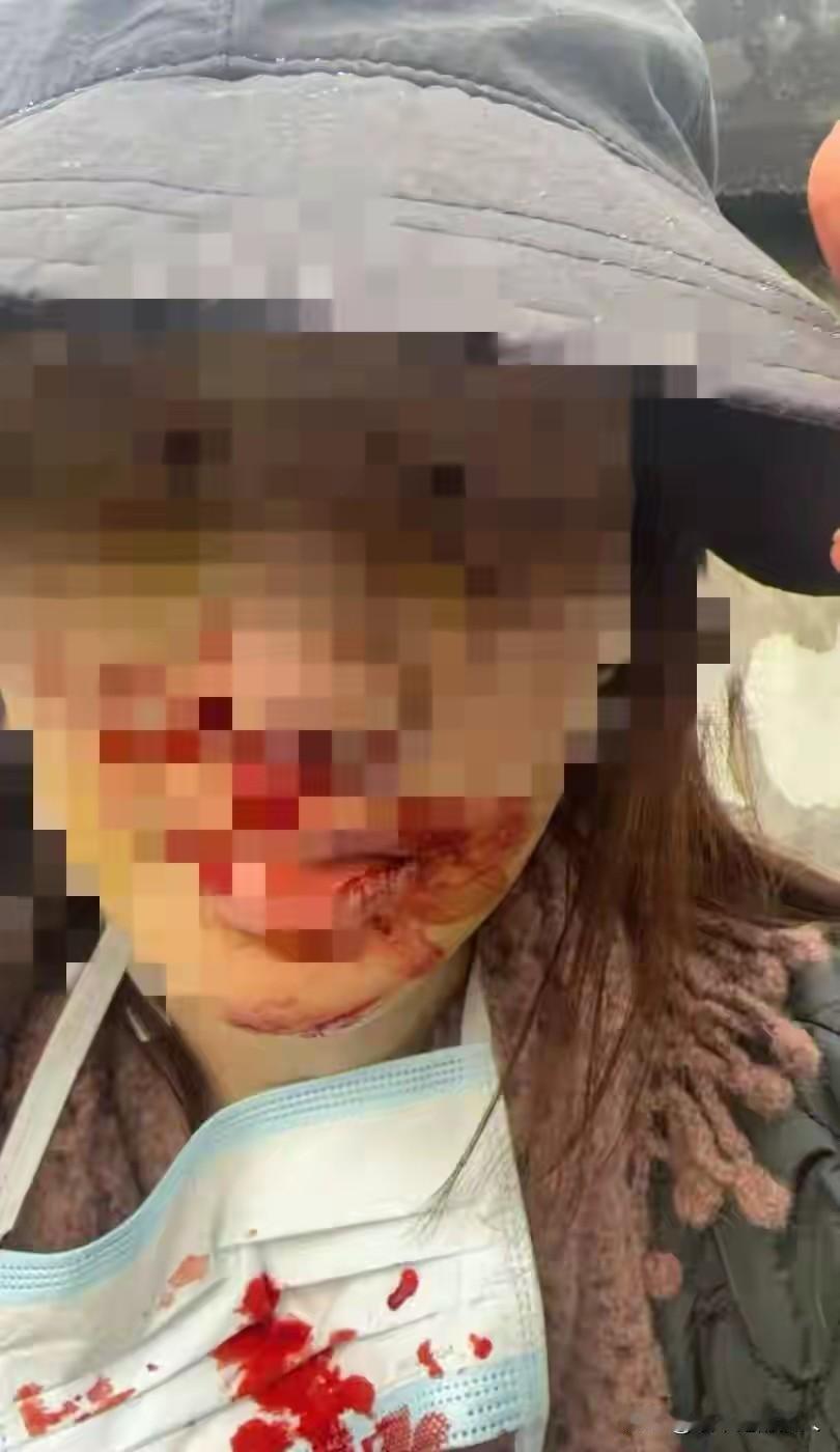 其实，其他不说，就凭这张照片，你们还不相信金晨吗？出了交通事故，抢救伤员是第一要