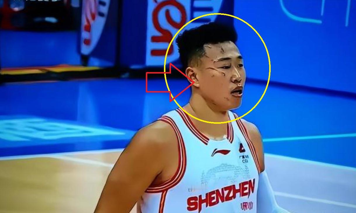 触目惊心！打了一场CBA比赛，整张脸都被“毁容”了球迷：还有没有王法？CBA