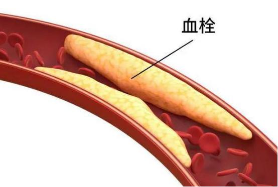 血管堵没堵，看脚就知道？提醒：若出现7种表现，或暗示血栓来临 你有没有注意