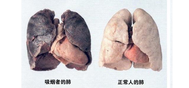 吸烟多久后, 肺会变黑?