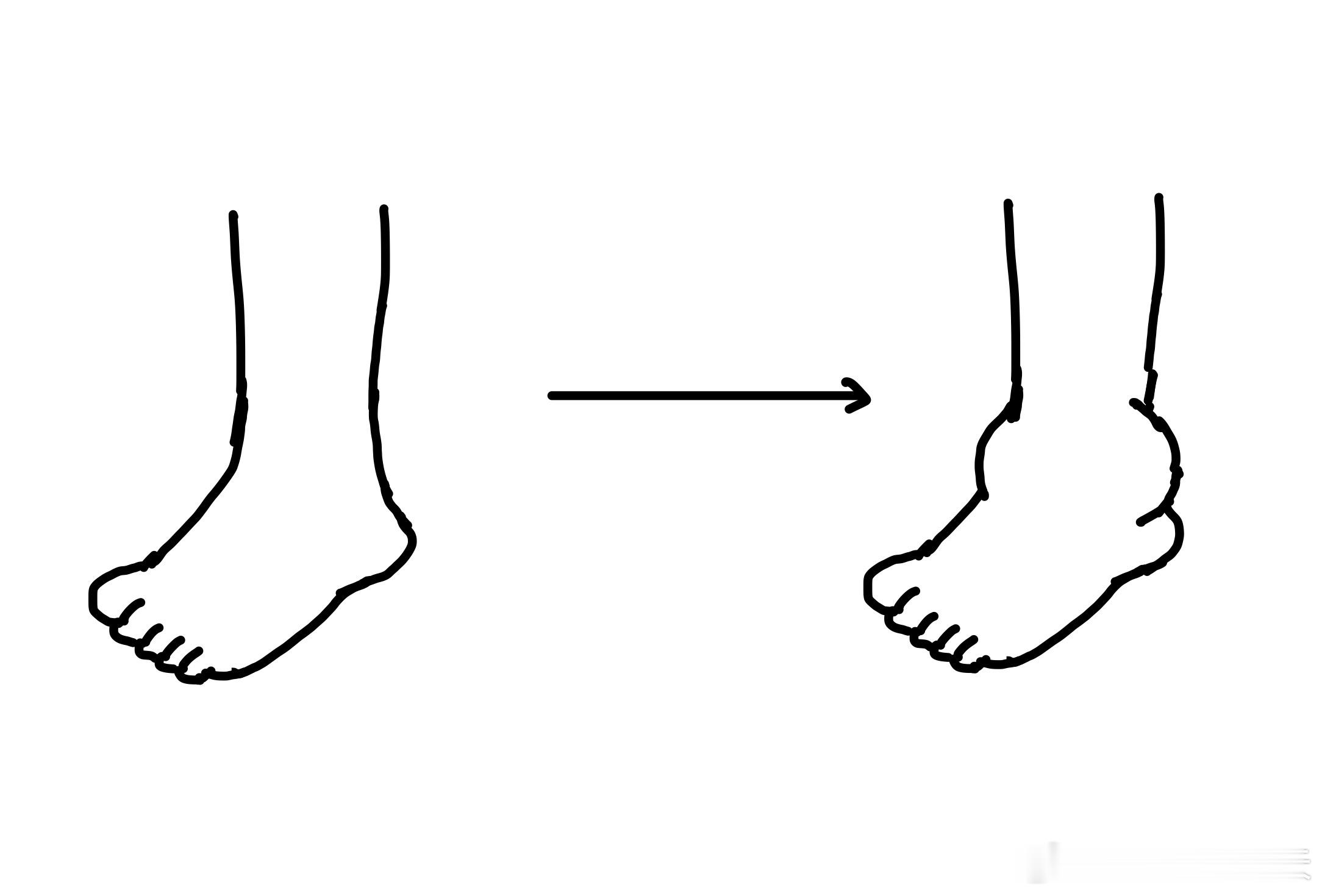 腿照来了！下楼梯崴到脚了[哭哭]​​​
