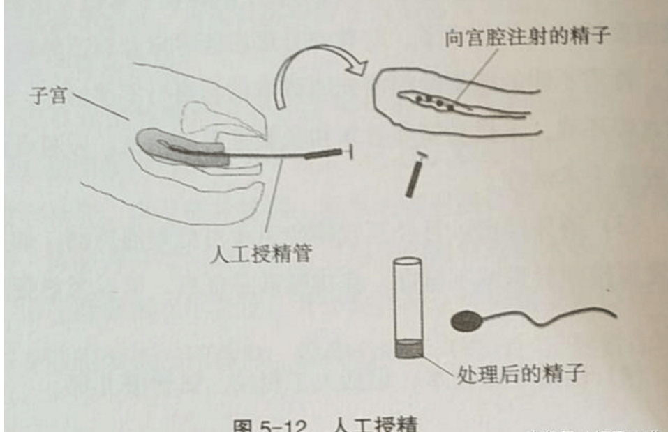 什么被称作人工授精? 是不是人人都适合?