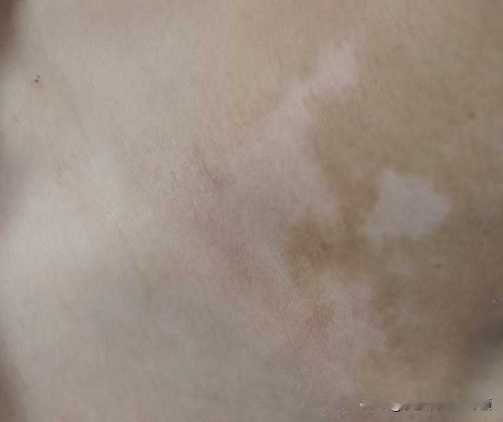 白癜风治好后会不会复发?白癜风虽然主要是以皮肤上出现白斑为典型表现的疾病，但本