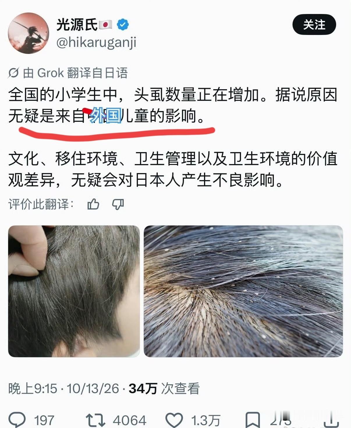 这都能怪到外国人头上。头虱在咱们这里不说绝迹，也差不多，90后好像就没有这个问