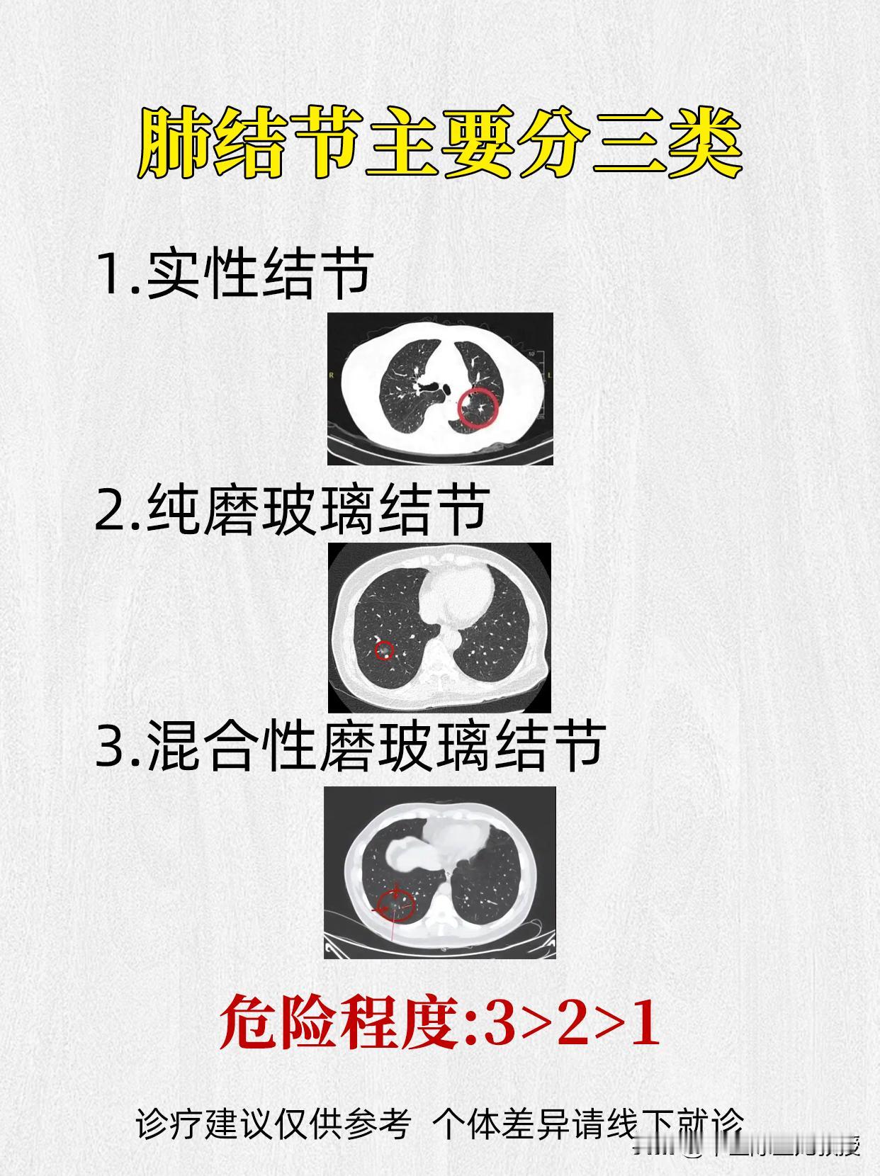 肺结节主要分三类，这些危险程度，要谨记！肺结节结节呼吸肺病