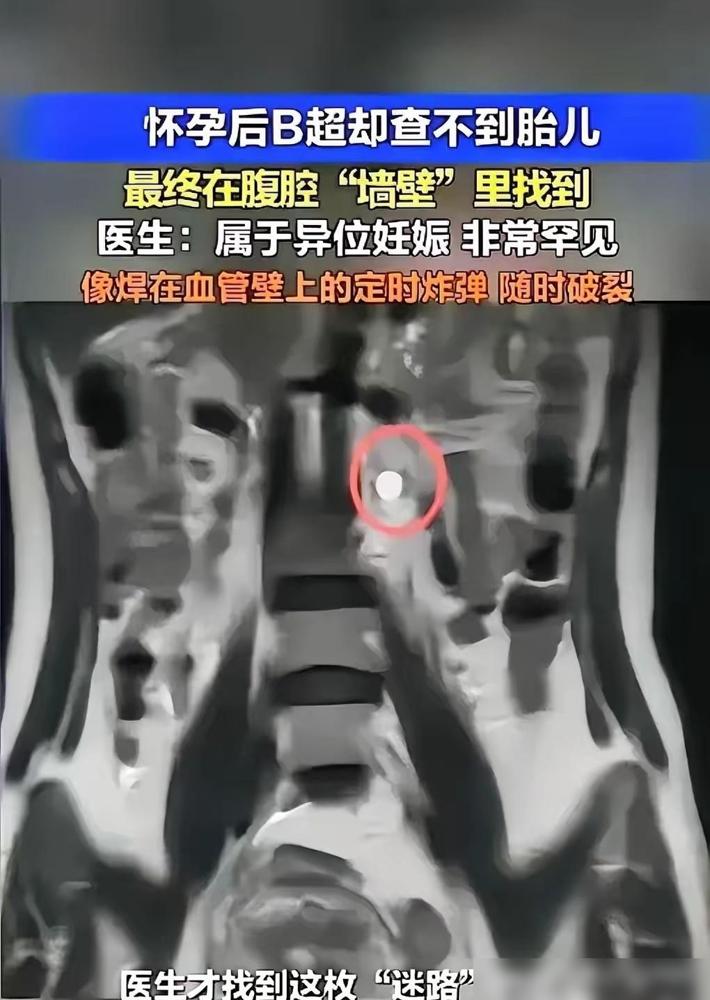 “太惊险了！”我这半辈子跑医院陪家人看病也不少，还是第一次听说胚胎能长在腹主