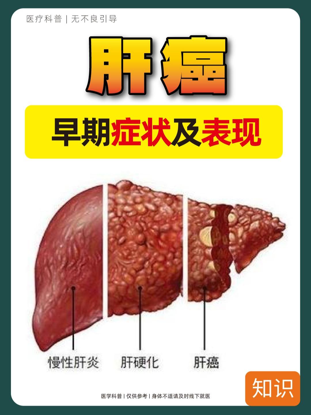肝癌，早期症状及表现，及时收藏！