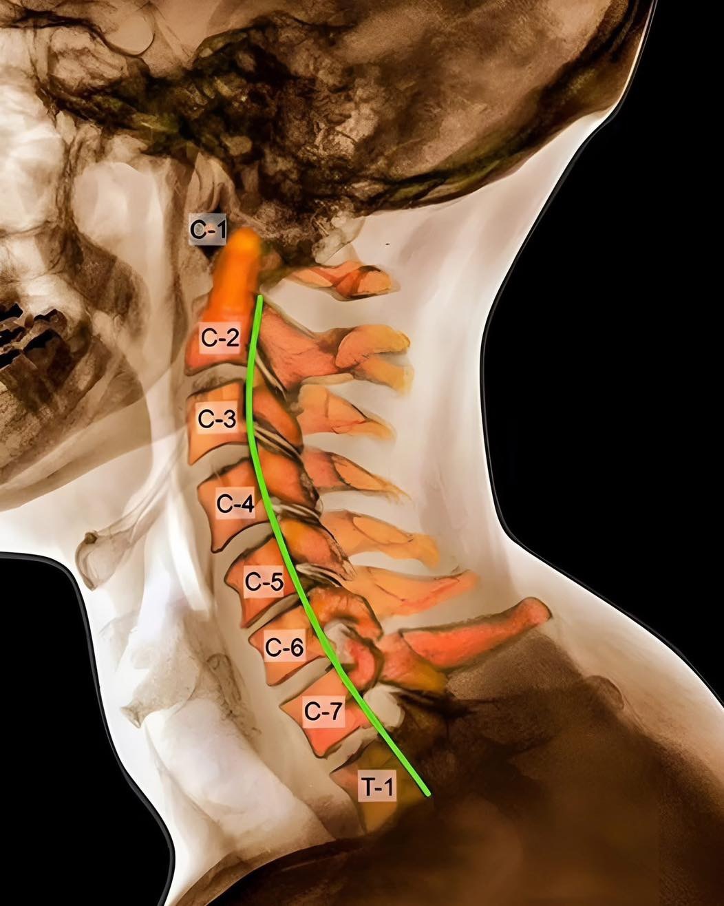 颈椎病为啥不要总低头？来看对比你就知道了👇🏻👇🏻我们的颈椎，本来正常的