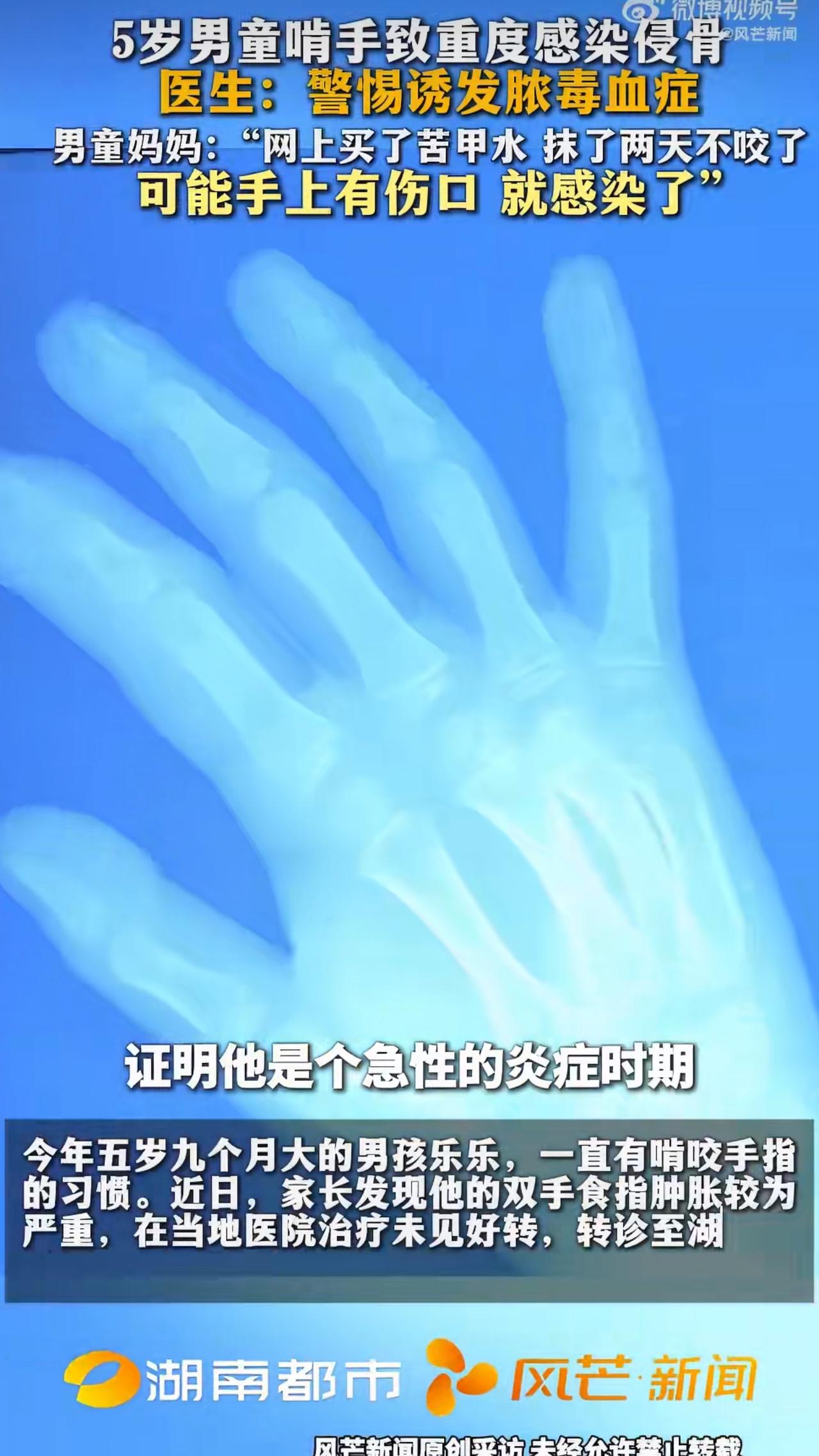 最近湖南有个5岁男童啃手指啃出大麻烦的新闻，让不少家长看了直冒冷汗。这孩子叫乐乐