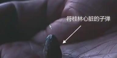 1995年，湖南人符桂林胸口中弹后被送往医院，医生检查了20多天，却始终找不到那