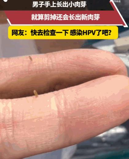 看着好瘆人！江苏，一男子看着手上那个不起眼的小肉芽，越看越碍眼，干脆心一横，找来