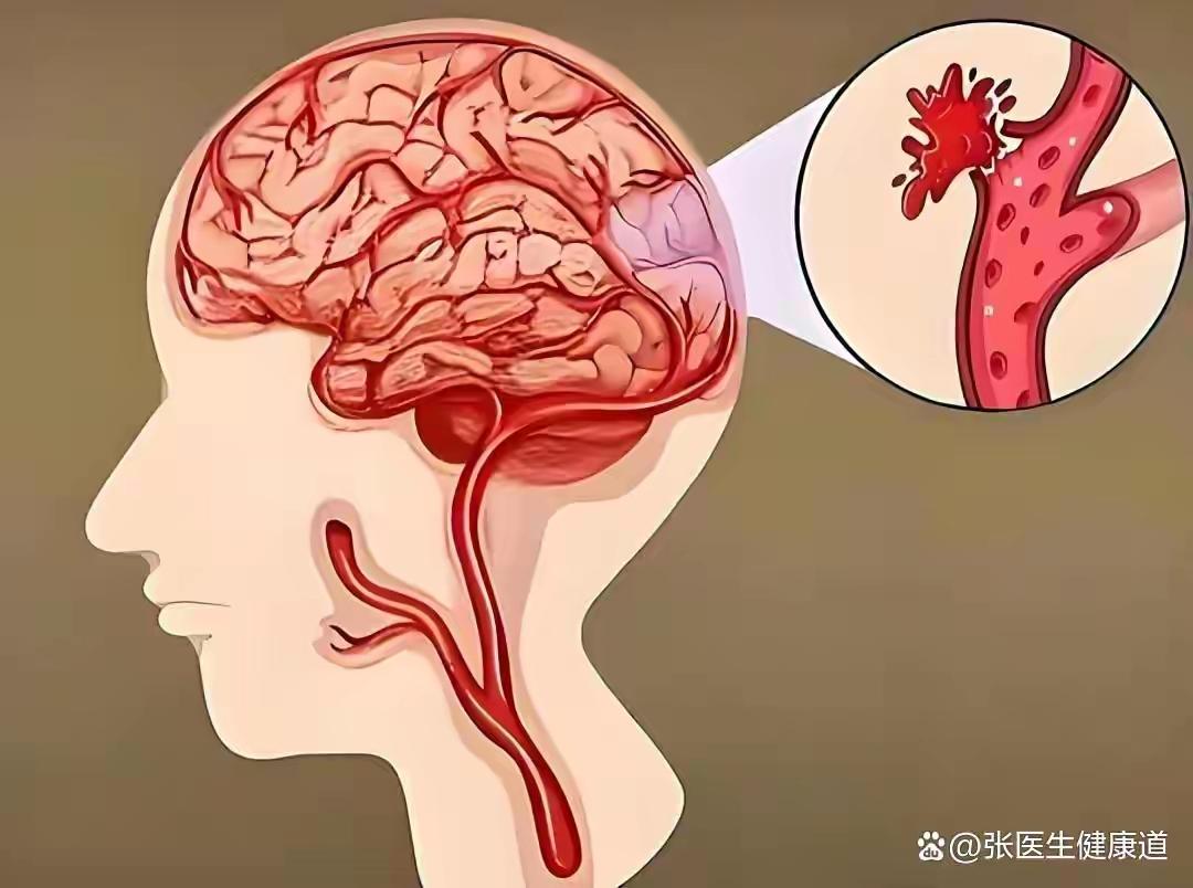 前阵子还在家族群抢红包的远房表哥，42岁，上周突然脑梗走了，平时看着连感冒都很少