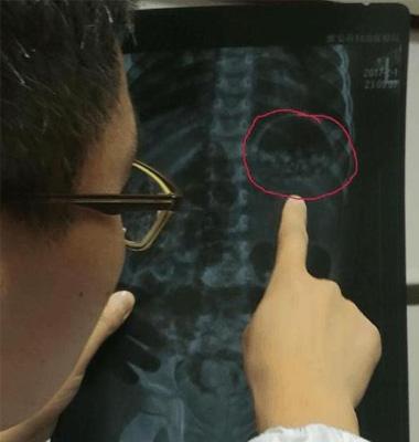 3岁宝宝肺里的东西, 医生都吓呆, 真相让妈妈当场吓哭!