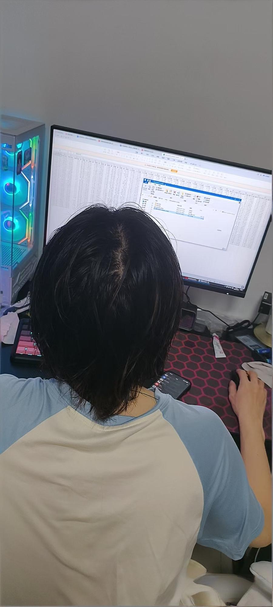 熬成了秃顶怎么办