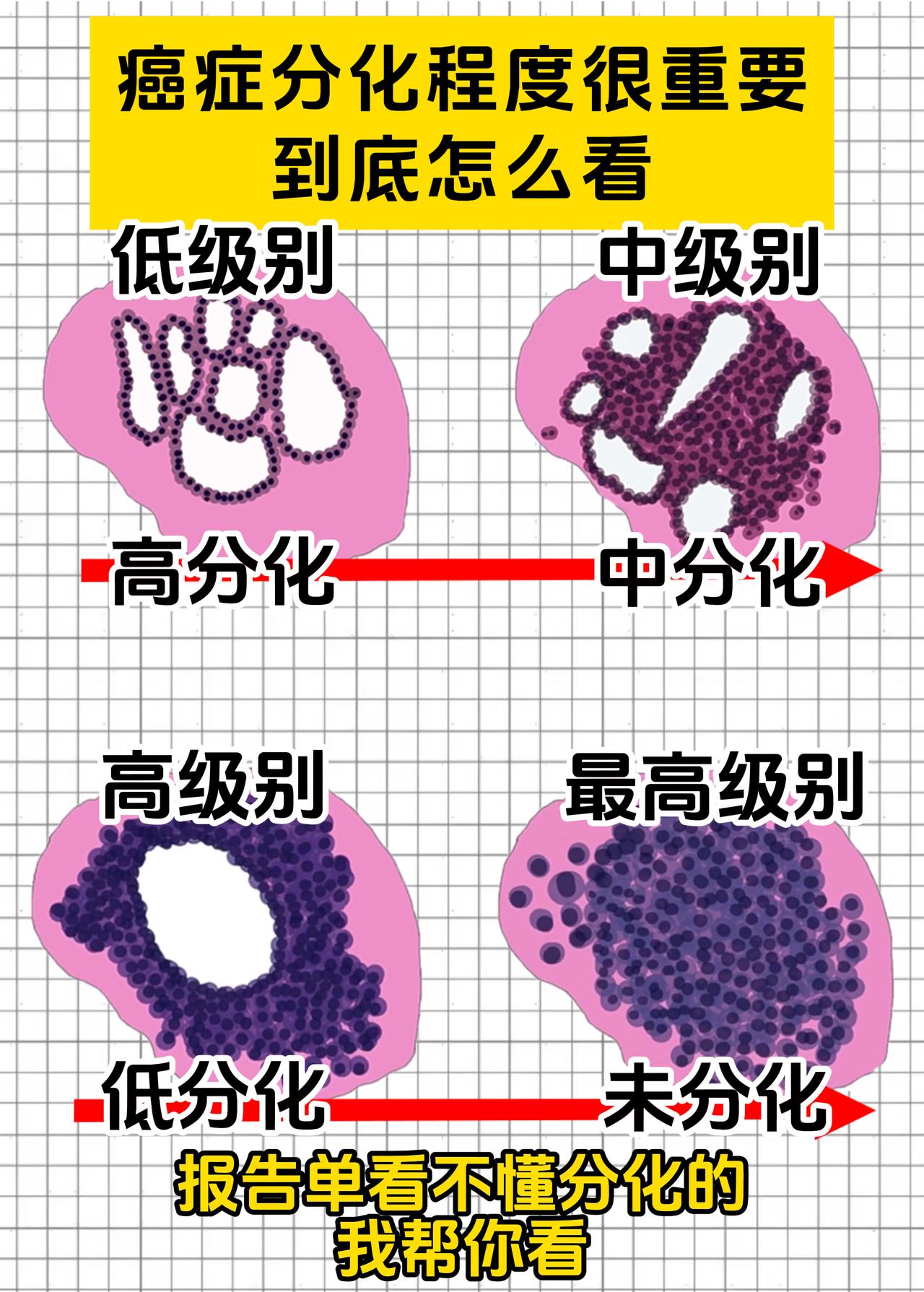 癌症分化很重要，患者单子上没有我帮您看