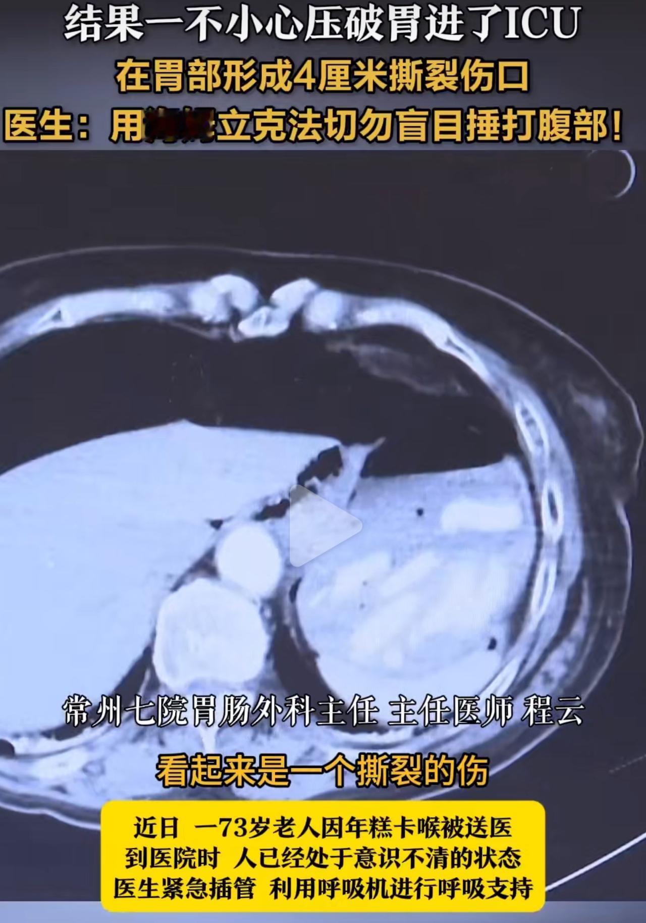 江苏一位73岁的老爷子，吃年糕的时候没留神，一下就卡了喉咙，气道堵得严严实实，连