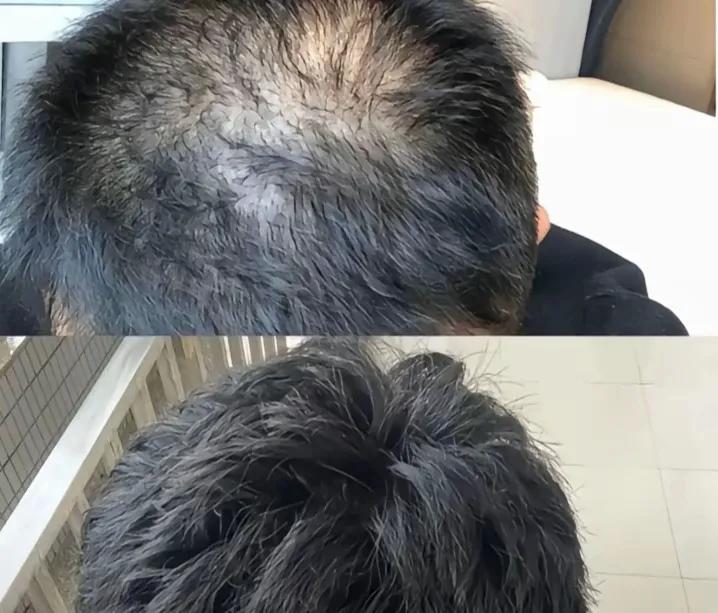 头发掉得厉害别乱花钱！大白透露防脱的3个秘密！近期大家总在问为什么掉了那么多