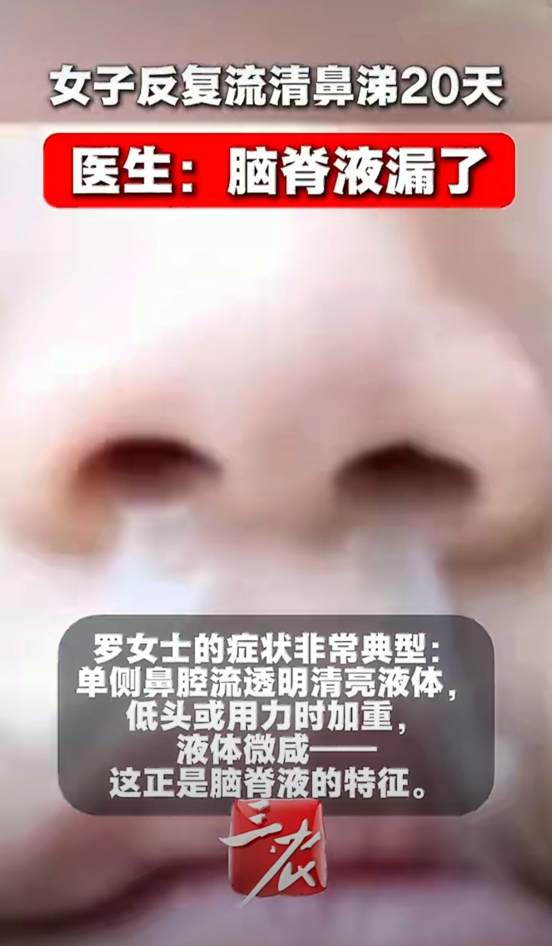 广东一位39岁的女士，连续二十多天总流清鼻涕，一开始她以为就是普通鼻炎，自己买了