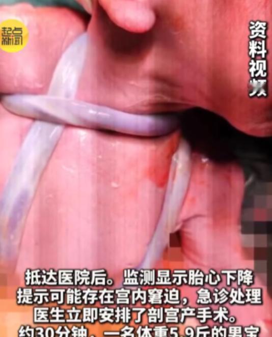 陕西，一怀孕的38周孕妇感觉到自己肚里的胎儿4个小时内只动了一次，她怀疑孩子可能