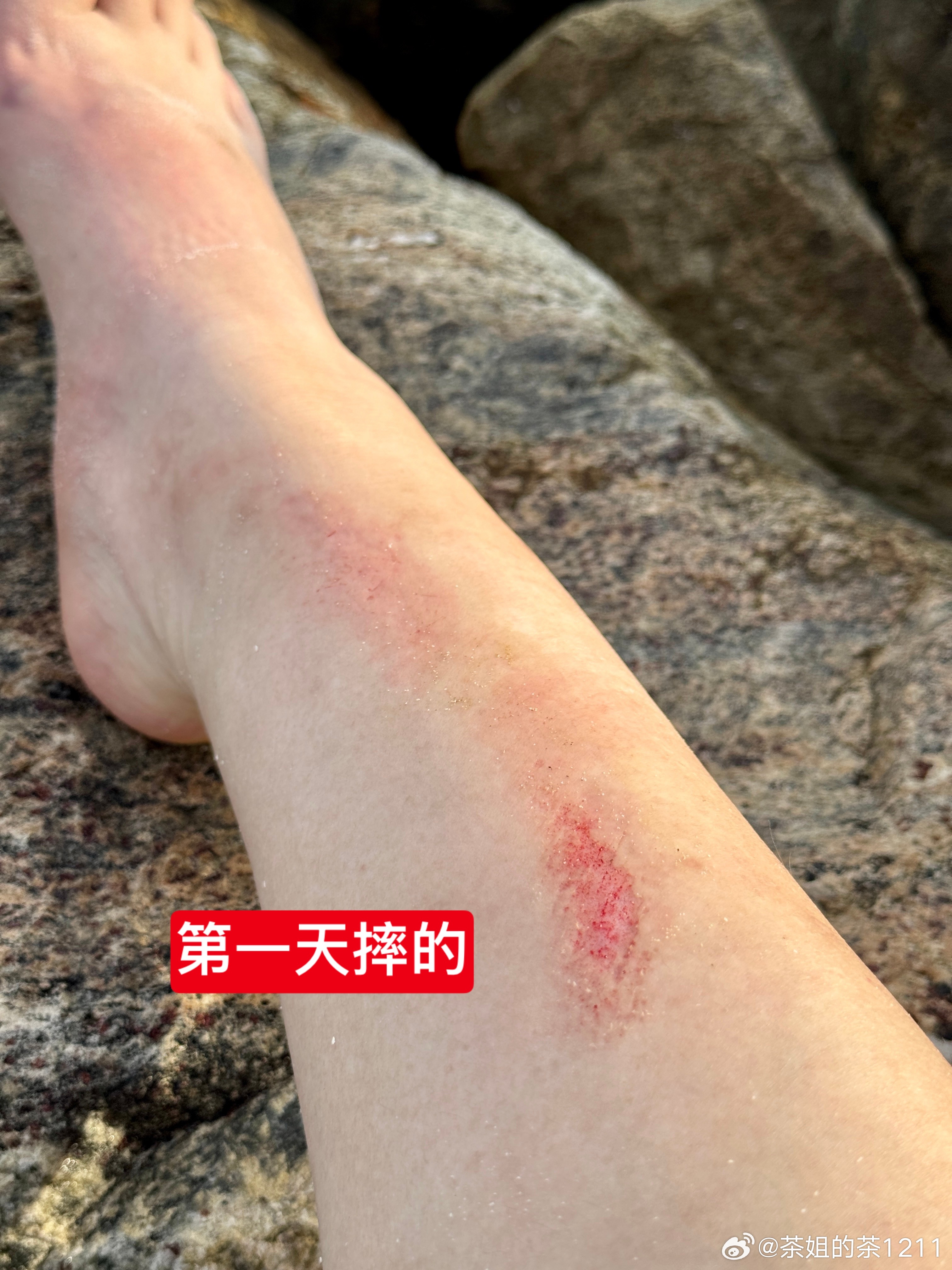 今天第四天，我的腿目前这个状态，今天能下水吗？当时是真的挖心的痛，反正一开始一片