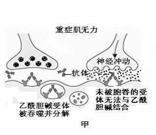 重症肌无力能不能生育以及怎么进行治疗