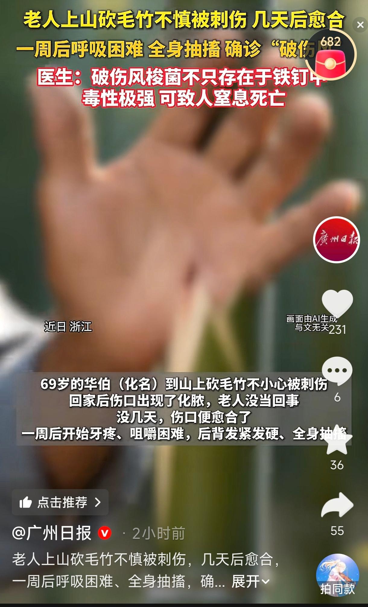 浙江，一69岁老人上山砍毛竹，左前臂被竹子刺了一下，伤口逐渐红肿，后来化了脓，他