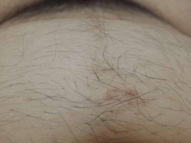 孕妇肚子上有黑毛毛, 怀的就是男孩吗?