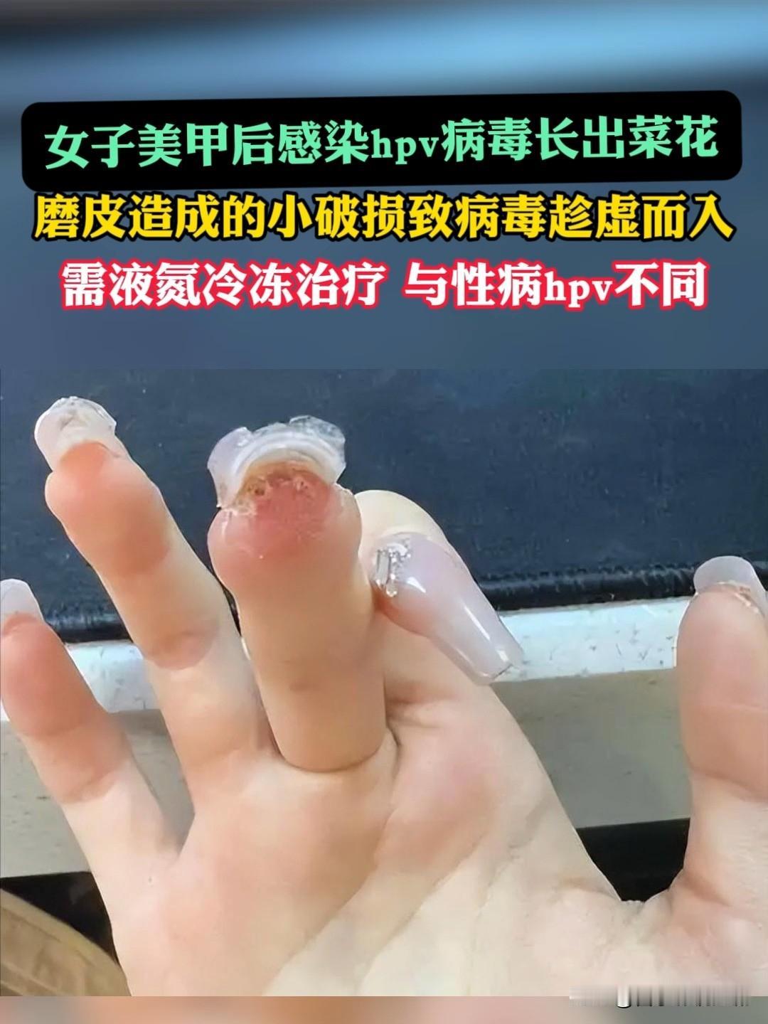 😱女子做完美甲后手指竟感染HPV！本想让指尖更精致，却因美甲工具消毒不到位，让