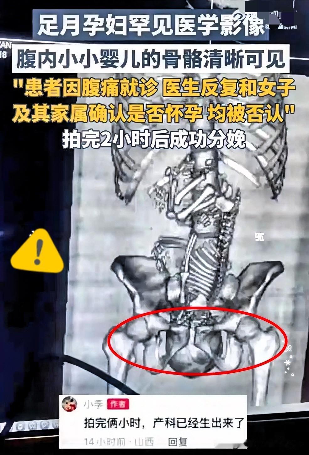19岁姑娘一捂着肚子就往医院跑，医生问她是不是怀孕了，她和家属一口咬定没有。后来