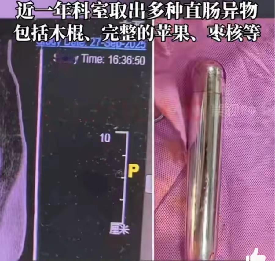 身体里去除异物，这是怎么进去的呢？