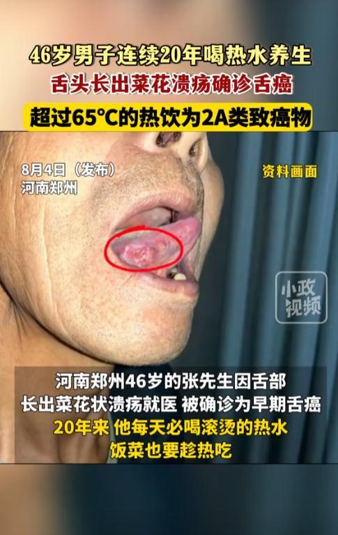 “悲剧还是发生了！”河南郑州，一46岁男子发现嘴里有菜花状的溃疡后，便紧急去医院