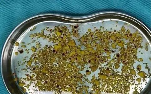 你可能曾听过“结石”这一词，但它真的可能悄悄地进入你的生活，成为健康隐患。在现代