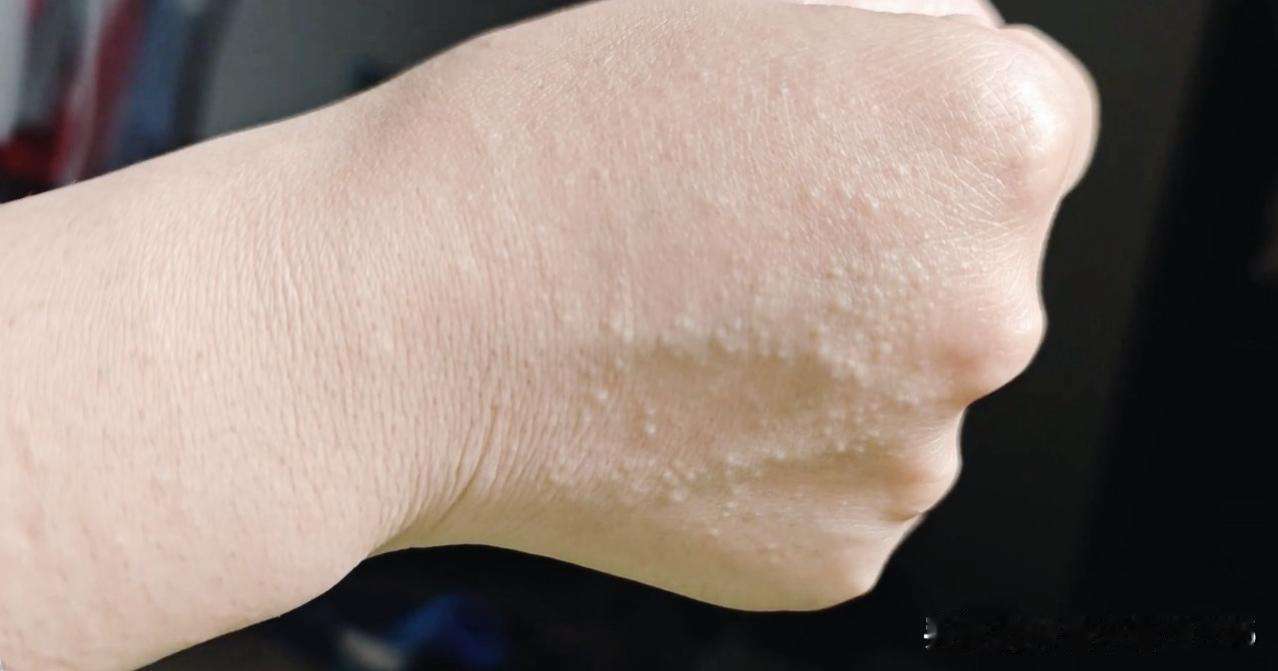 什么原因造成的手上最近起了一层小水泡，可痒痒了。从小皮肤就好，除了是容易过敏的