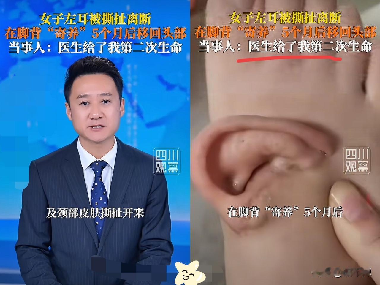 天下之大无奇不有！山东一女子因为意外，导致左耳断裂，送医后，医生竟想出把耳朵“