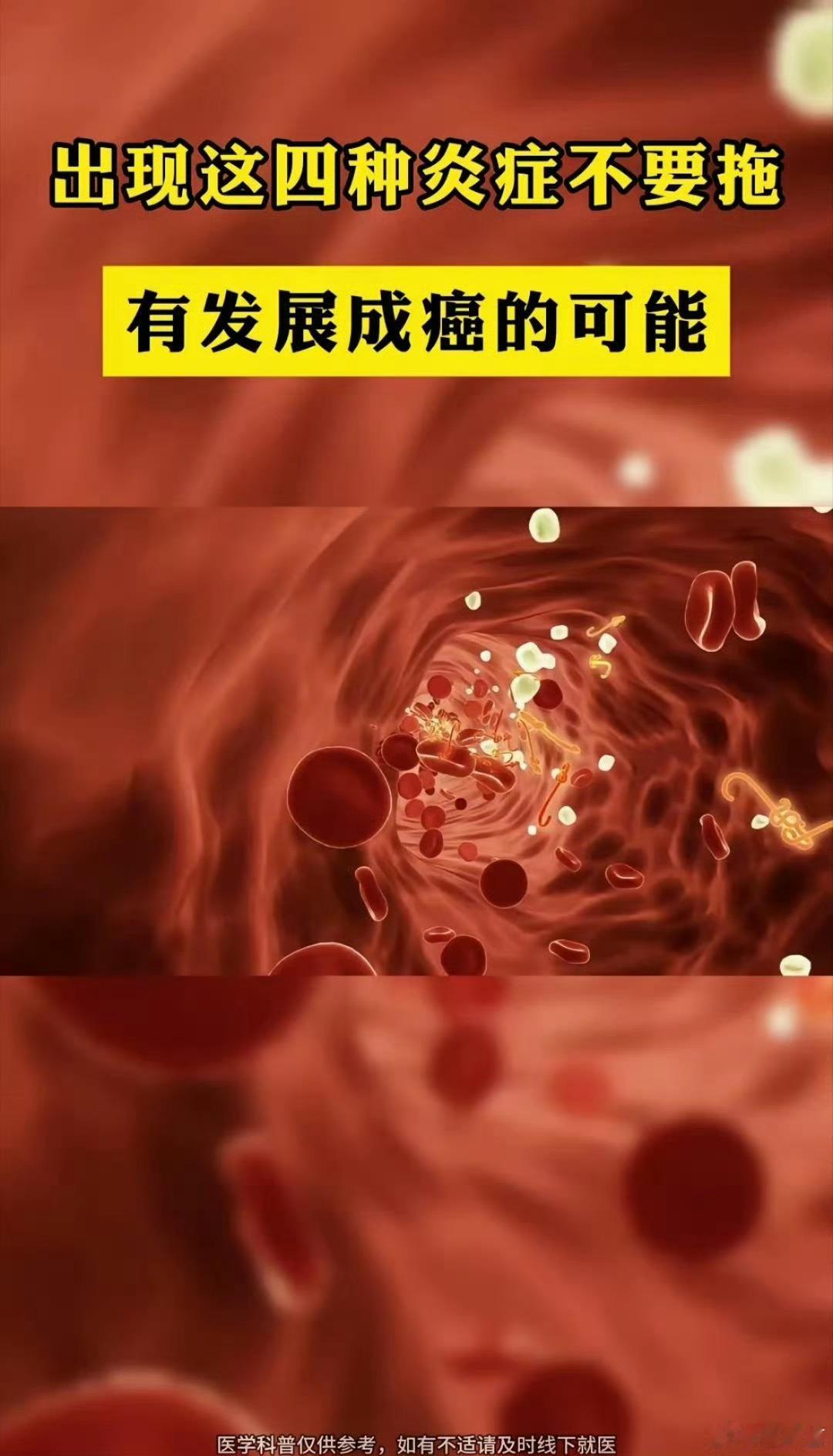 患上4种炎症拖下去小心癌变身体有炎症一定要及时就医呀，千万不要拖，搞不好小病就发