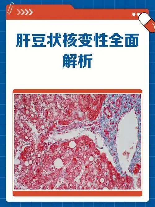 肝豆状核变性‌是一种常染色体隐性遗传的铜代谢障碍疾病，主要因ATP7B基因突变