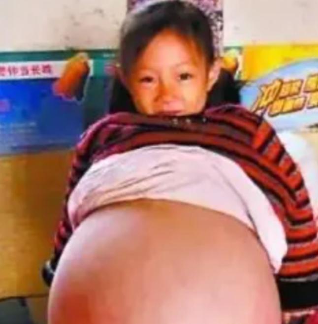 山西一个4岁小女孩，肚子鼓得像足月孕妇。多家医院诊断后，医生断言她活不过三个月。
