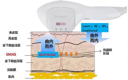 做超声刀有后遗症吗? 做超声刀有何副作用?