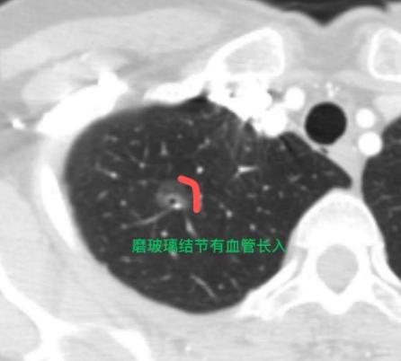 这样的肺磨玻璃结节,考虑是早期肺癌,怎么还会被误诊?这位57岁的女士专程从外地来