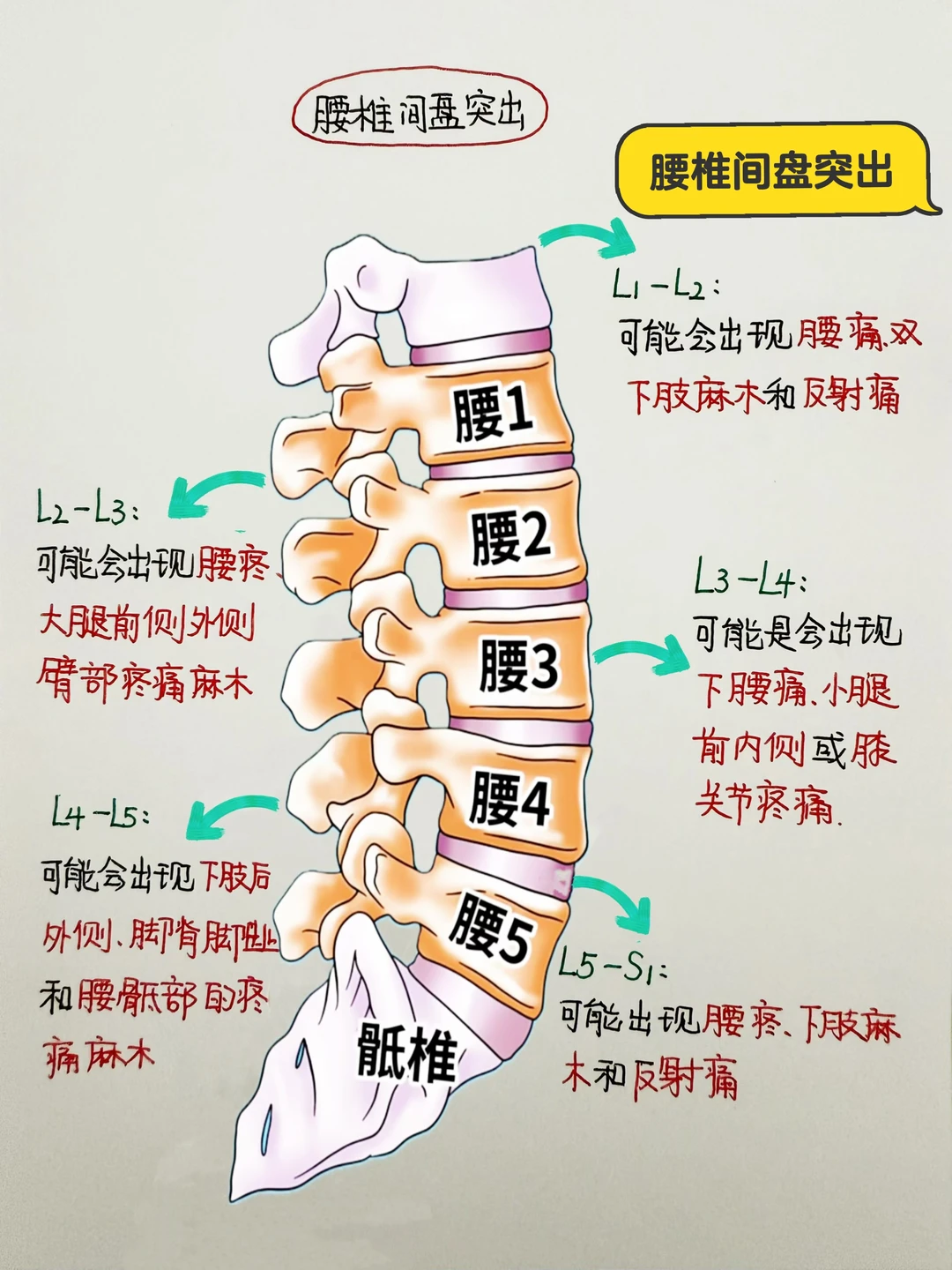 今日学习打卡——腰椎间盘突出
