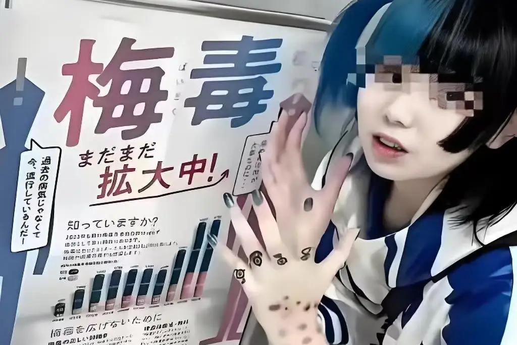要警惕！日本梅毒泛滥，青霉素大量短缺，"晒梅毒"竟成潮流？一种能烂到骨头里、能传