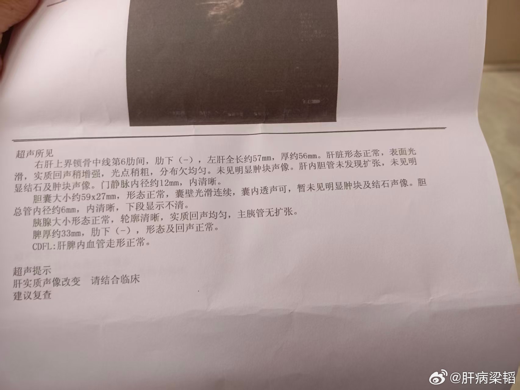 肝脏彩超回声增粗：主要和超声成像原理有关。一是肝细胞脂肪变性，脂肪成分反射较强，
