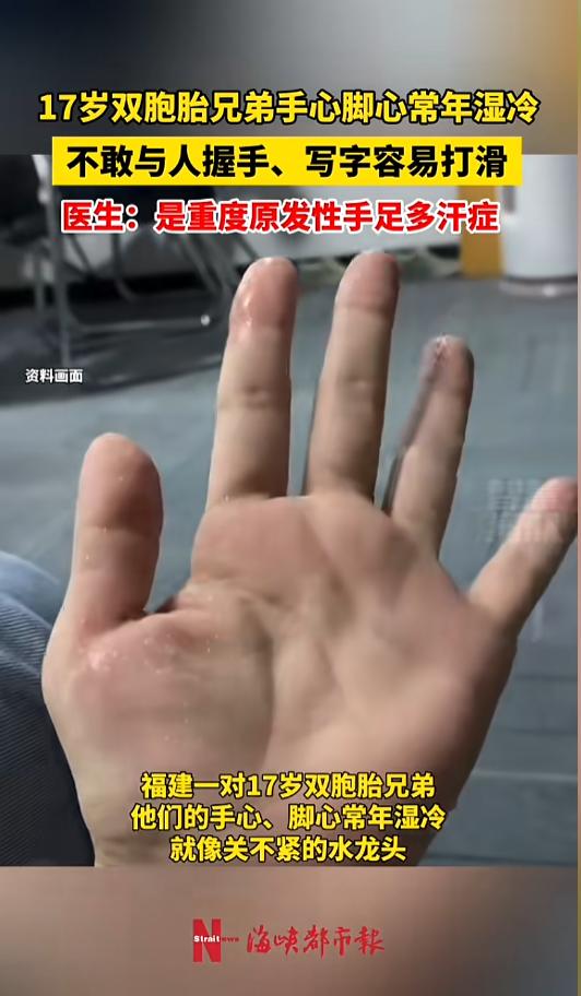 “开眼界了！”近日，福建漳州，一对儿双胞胎因为手掌长年冒汗到医院寻求治疗。医生检