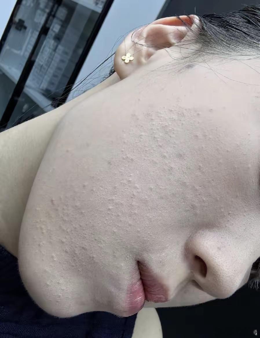 工作连续化了一个月妆，就成这样啦！咋办呀！不化妆时不咋明显，一化妆就超级明显。这