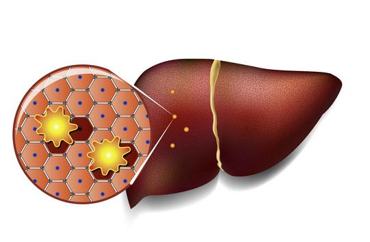 为什么几乎一口肉都不吃了，最后还是得了脂肪肝？ 你以为不吃肉就能避开脂肪肝？