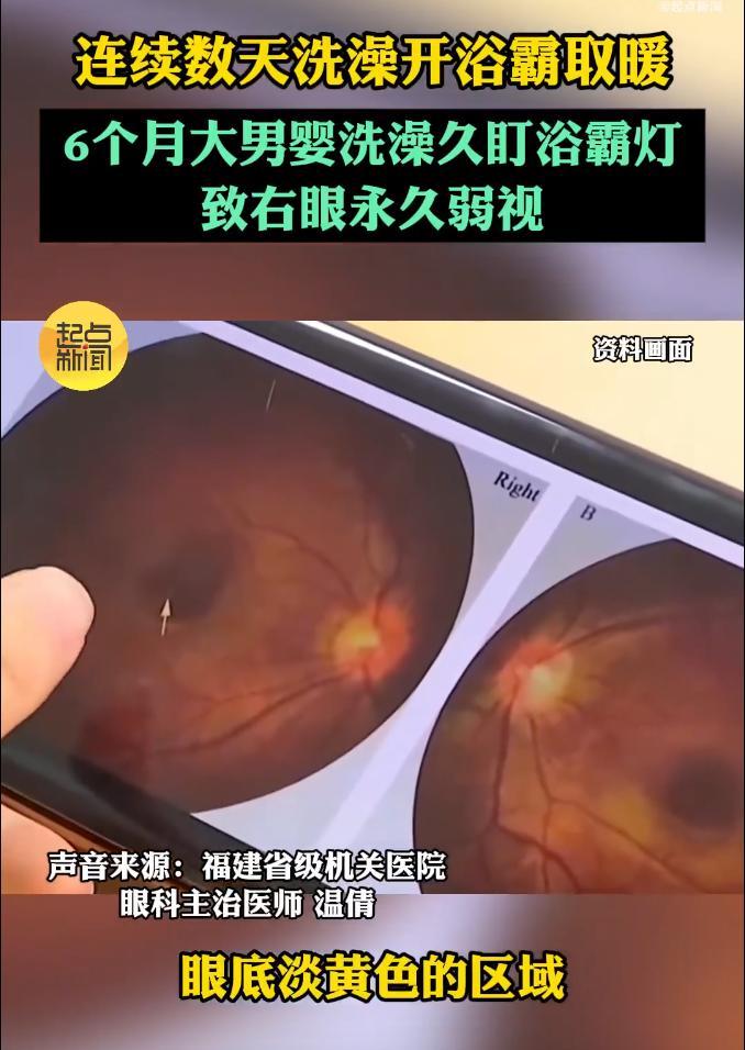 6个月大男婴洗澡时直视浴霸灯光，右眼视网膜灼伤，致终身弱视，医生：家长太粗心了
