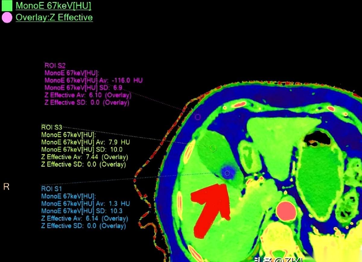 我跟你讲个事儿，绝了。一个阿姨，肚子疼了20天，跑去做CT，报告白纸黑字写着：