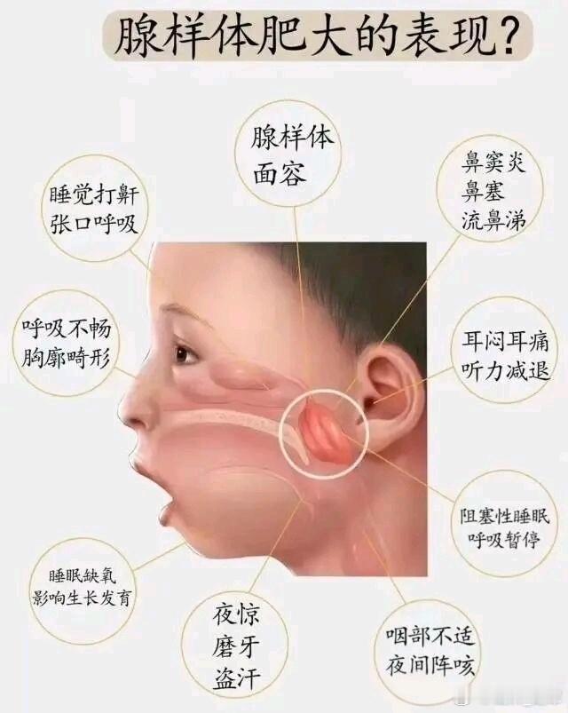 广成中医推荐的鼻炎，腺样体肿大方子白芷3克、独活3克、辛夷3克、荆芥3克、双花6