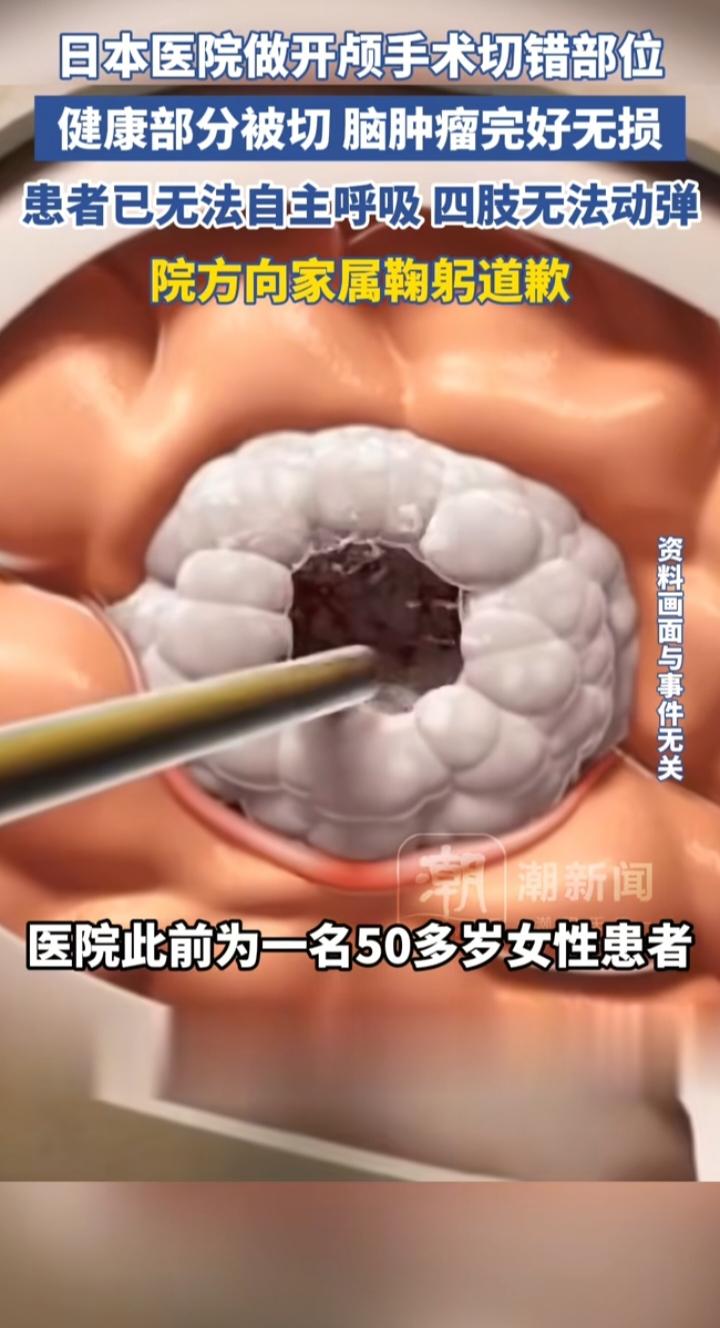 日本开颅手术切错部位，我却看到最恐怖的三个字：我以为看完这条新闻，我后背发